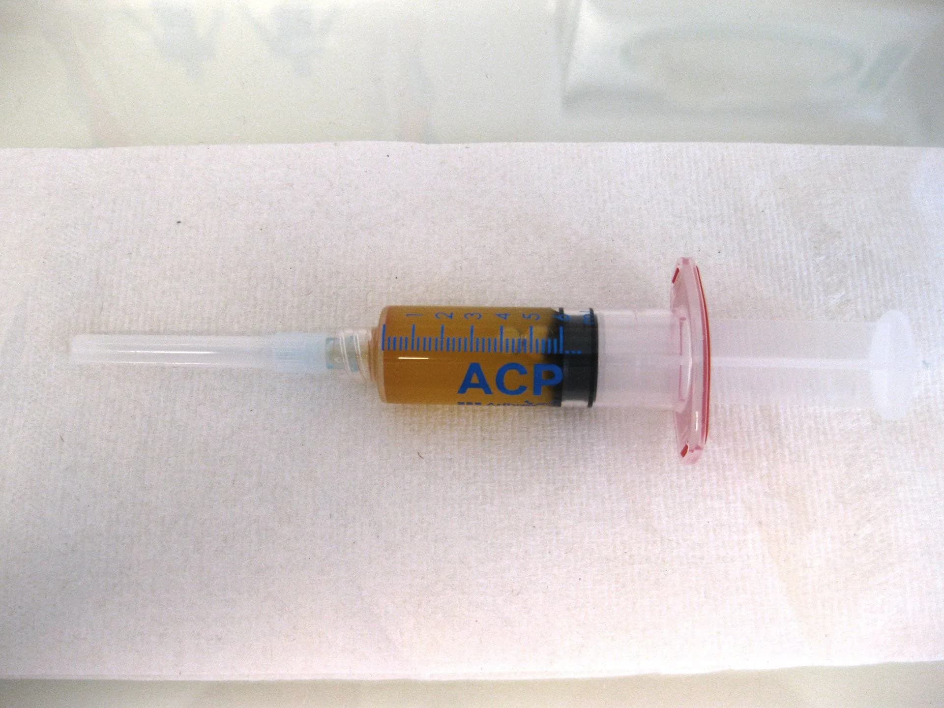 Aufgezogene ACP-Spritze mit goldgelbem plättchenreichem Plasma, bereit zur Injektion